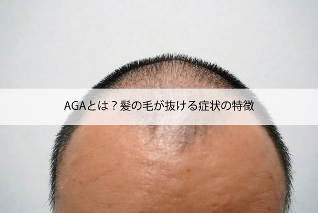 AGAとは？髪の毛が抜ける症状の特徴