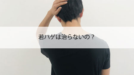 若ハゲは治らないの？